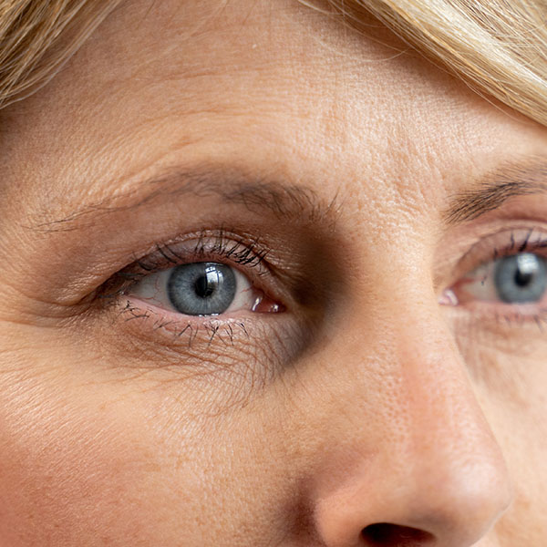 Facial Lines Causes and Treatments Zia Cosmetic Clinic